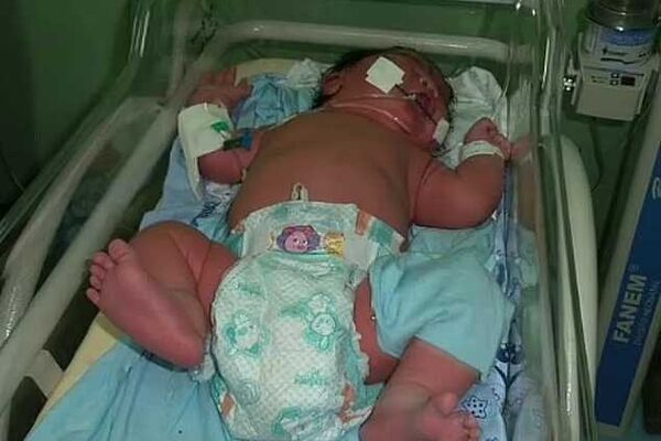 تولد این نوزاد در برزیل همه را شگفت زده کرد! + عکس